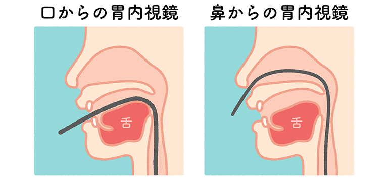 経鼻内視鏡による胃カメラ検査