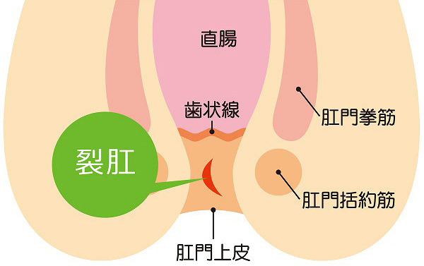 切れ痔(裂肛)