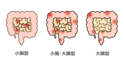 クローン病