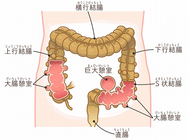 大腸憩室とは