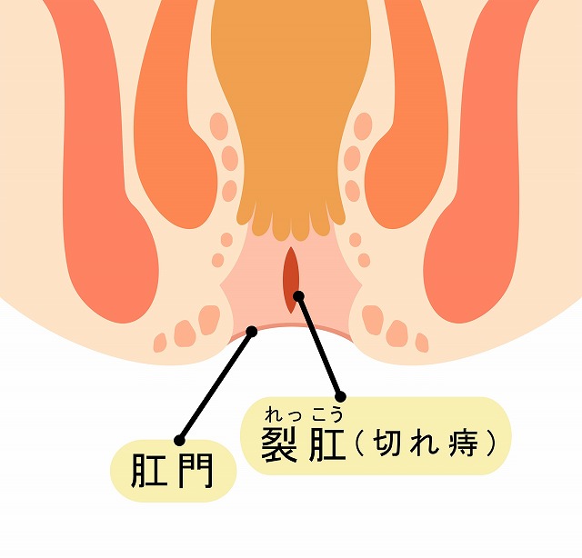 きれ痔